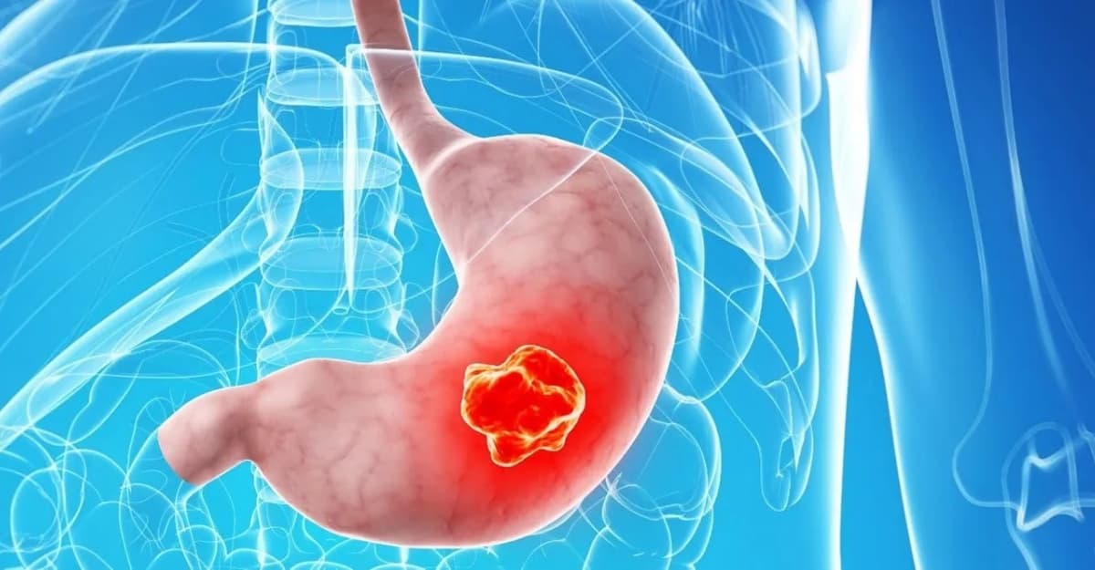 Ung thư dạ dày có lây không? Sự thật về nguy cơ từ vi khuẩn HP
