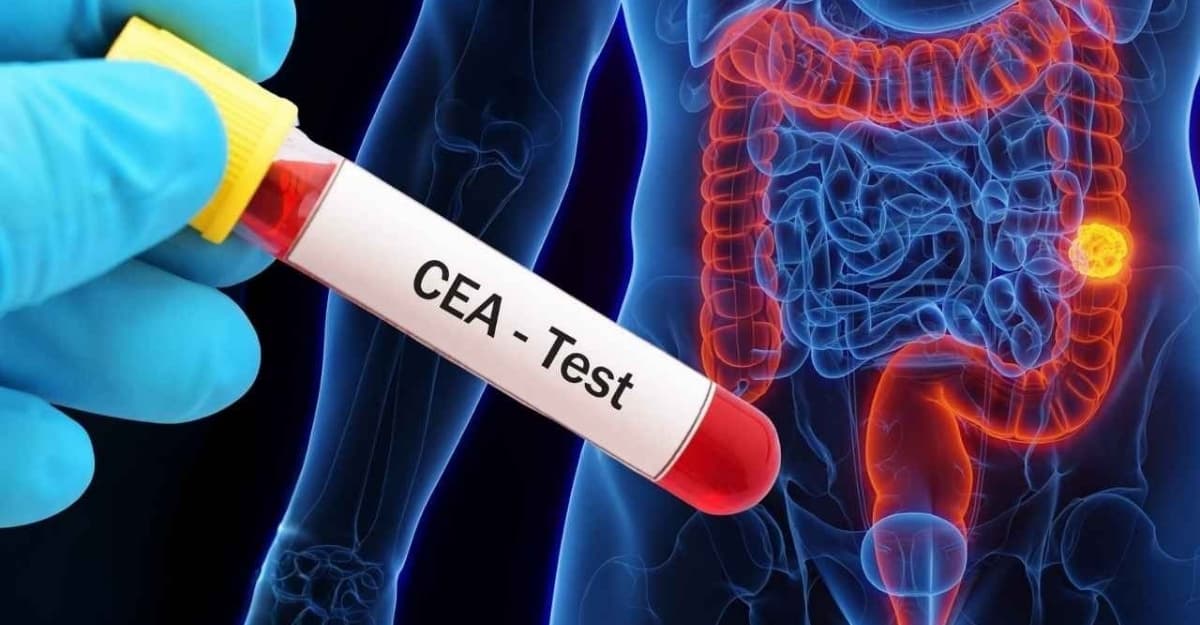 Marker ung thư đại tràng: Ý nghĩa các chỉ số và lưu ý cần biết
