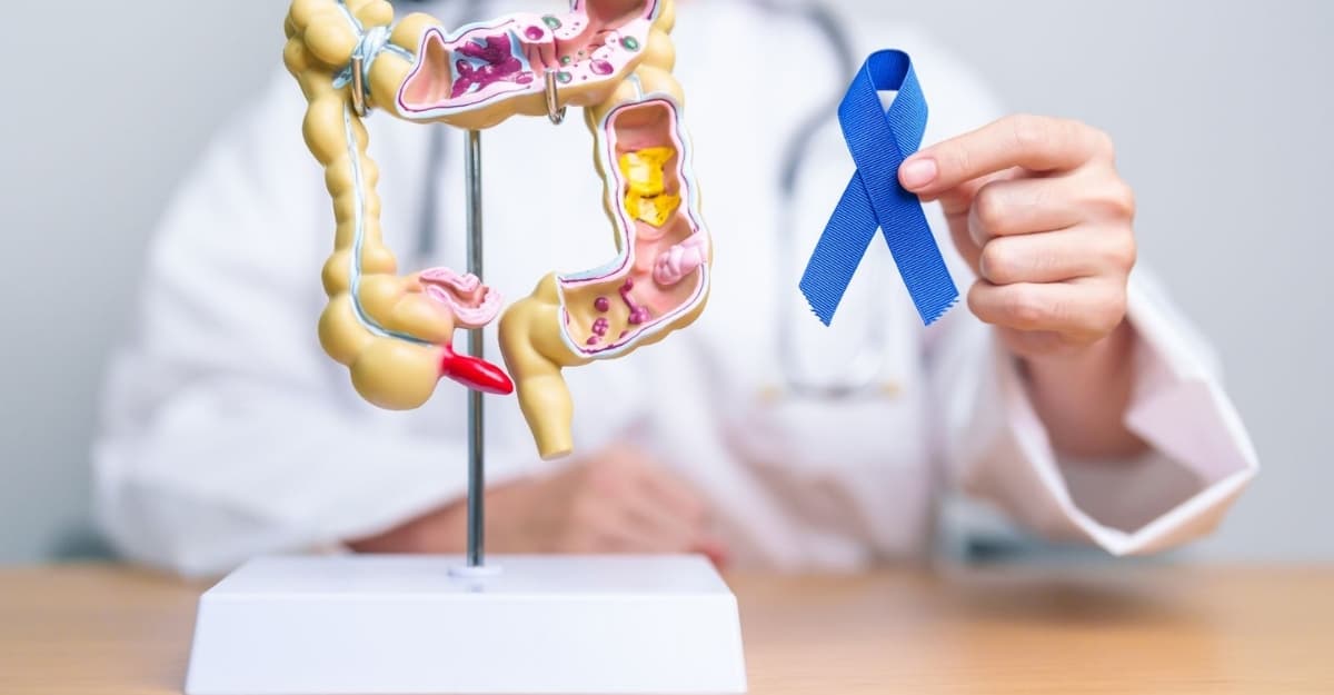 Bệnh ung thư đại tràng có lây không? Các triệu chứng nhận biết
