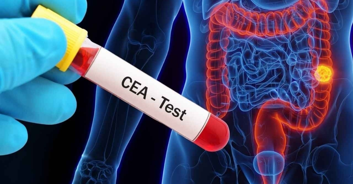 Marker ung thư đại tràng: Ý nghĩa các chỉ số và lưu ý cần biết