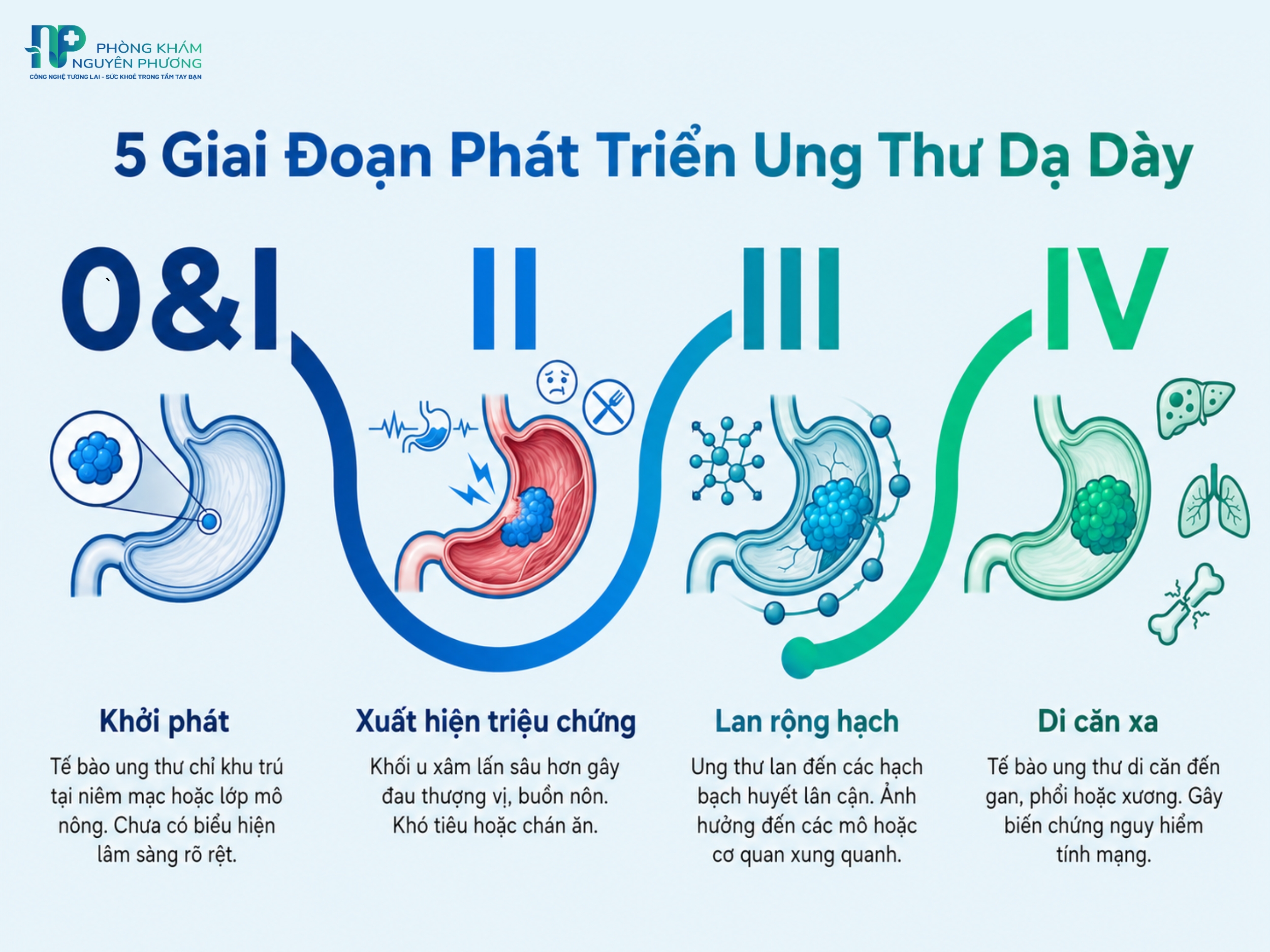Các giai đoạn tiến triển của ung thư dạ dày