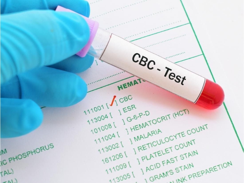 Xét nghiệm công thức máu toàn phần (CBC) giúp sàng lọc và phát hiện sớm tan máu bẩm sinh