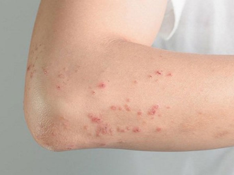 Giai đoạn đầu HIV khó nhận biết, có thể xuất hiện phát ban toàn thân