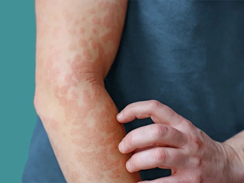 Lạm dụng truyền nước hoa quả có thể gây sốc phản vệ